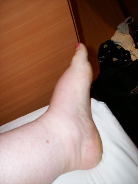 5 Swollen Foot - 100_1249 - 12.30.06 07.57