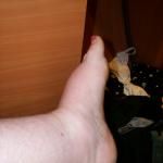 5 Swollen Foot - 100_1250 - 12.30.06 07.57