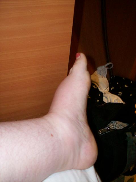 5 Swollen Foot - 100_1250 - 12.30.06 07.57